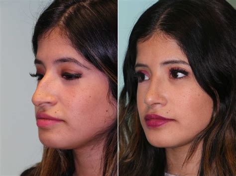 Rhinoplasty Photos Chevy Chase Md Patient 13069