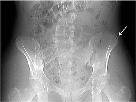 Left Iliac Crest Apophysitis - ovulation symptoms