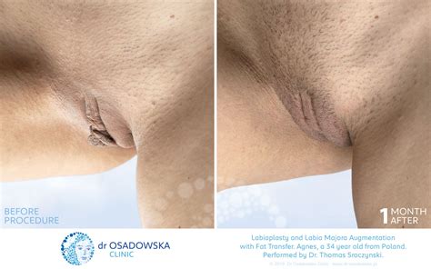 Real Photos Labiaplasty And Fat Transfer To Labia Majora Dr Osadowska Clinic Poland