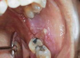 These white spots may become larger and join together and form patches known in medical terms as plaques. Oral Cancer Images - The Oral Cancer Foundation