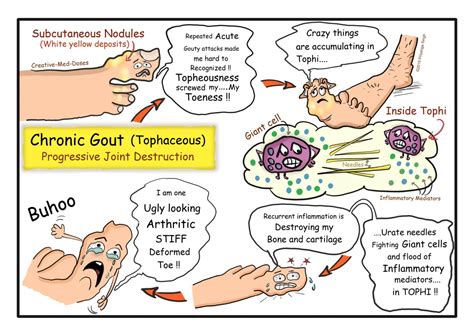 Gout Crystal Induced Arthropathy Creative Med Doses