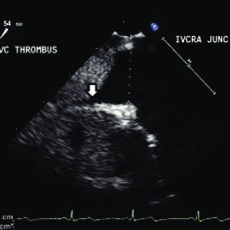 A Mid Esophageal Right Ventricular Inflow Outflow View Showing The