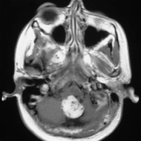T1 Weighted Sagittal View Showing A Hypointense Lesion In The Posterior