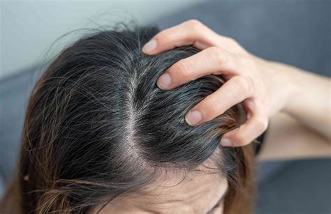 Oily Itchy Scalp With Bumps Ecampusegertonacke