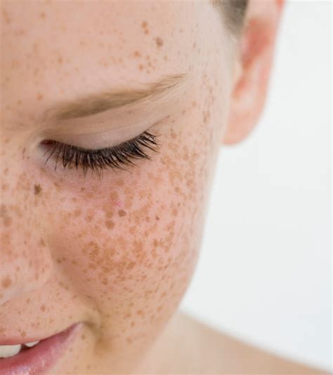 Sun Damage Conditions Premier Dermatology