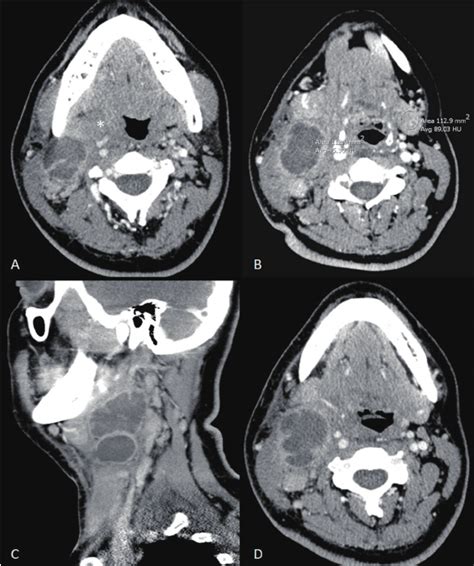 Contrast Enhanced Ct Of The Neck Demonstrates Right Level Iiiii Cystic