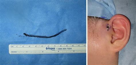Early One Stage Surgical Treatment Of Infected Preauricular Sinus