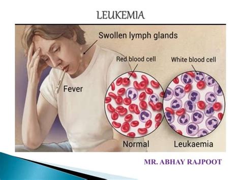 What Is Acute Lymphoblastic Leukemia
