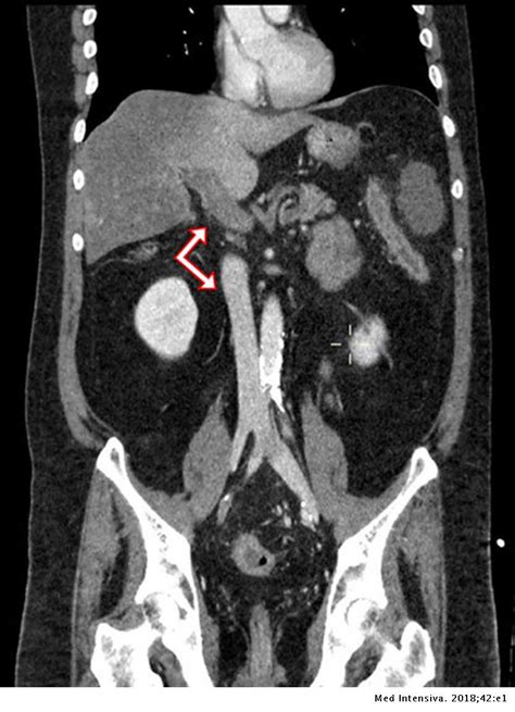 El tromboembolismo pulmonar (tep) es el resultado de la obstrucción de la circulación arterial pulmonar por un émbolo procedente, en la. Trombosis arterial y venosa masiva | Medicina Intensiva