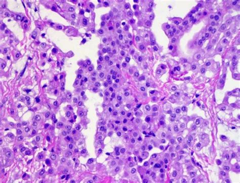 Epithelioid Mesothelioma Pathology Outlines Goimages 411
