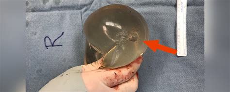 Woman S Breast Implant Saved Her Life By Deflecting A Bullet Case