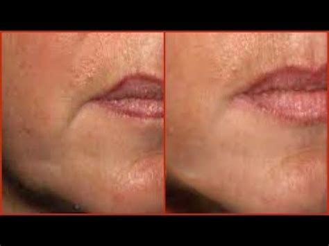 We did not find results for: HOW TO QUICKLY GET RID OF FROWN LINES AND MOUTH WRINKLES ...