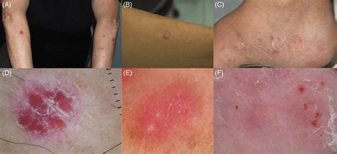 Clinical Presentation A On The Arms Of Guttate Psoriasis And
