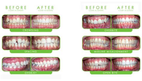 Clear braces cost in malaysia is higher than the traditional metallic braces. Clear Braces | Clear Braces Cost | Pawleys Island Dental ...