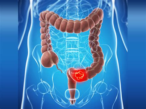 Causes And Symptoms Of Colon Cancer Styles At Life