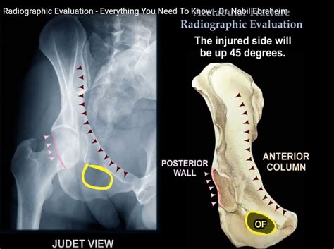 Radiographic Evaluation Of Acetabular Fractures —