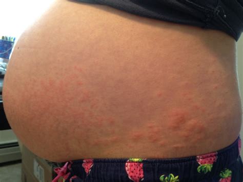 Pruritic Urticarial Papules And Plaques Of Pregnancy Puppp Rash