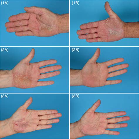Albums Pictures Pictures Of Eczema On Fingers Full HD K K
