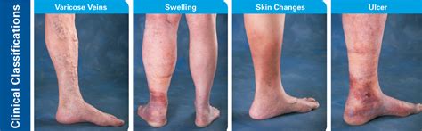 Varicose And Spider Veins Center For Vein Care