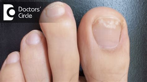 Causes Of White Spots On Your Toenails My Footdr Atelier Yuwaciaojp