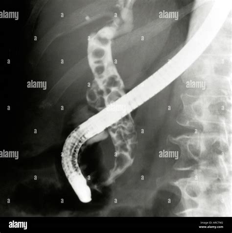 Endoscopic Retrograde Cholangiopancreatography Erpc X Ray Image Of