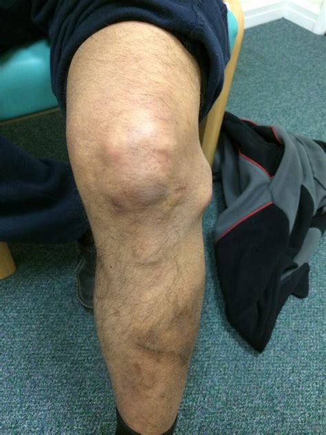 The Sp⚽️rts Physio On Twitter Knee Gurus 152 After Meniscal Cyst Op