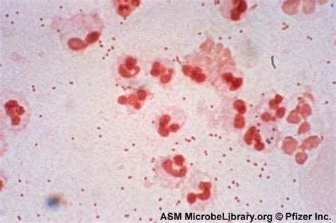 Haemophilus influenzae bacteria most often cause pneumonia, bacteremia, and meningitis mostly in infants and children younger than five years of age. MME: Gram Negative Bacteria at University Of Arizona ...
