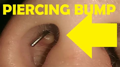 How To Get Rid Of A Piercing Bump Inside Nose Youtube