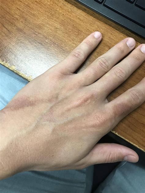 Discoloration On Hands 5 Days Since I Noticed It And Only Slight