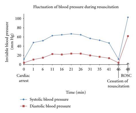 Blood Pressure Bp Fluctuation During Cardiac Arrest In Our Patient