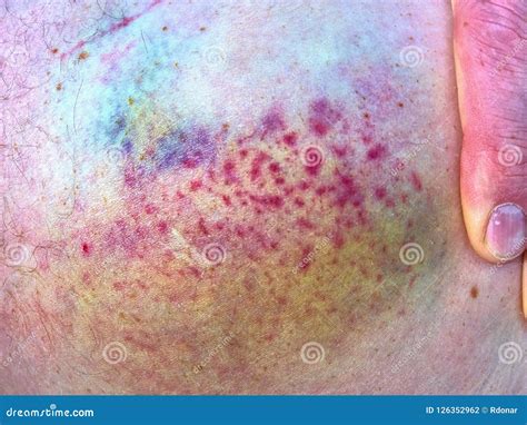 Close Up Of Bruise On Wounded Woman Leg Skin Royalty Free Stock Photo