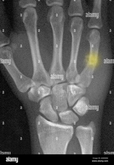 X Ray Of The Hand Of A Man Showing A Healing Boxers Fracture A Break