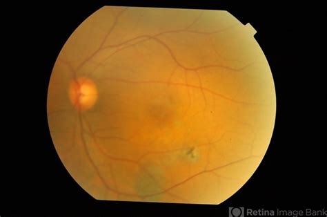 Bilateral Chronic Central Serous Chorioretinopathy Retina Image Bank