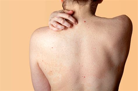 Dermatite Allergica Sulla Pelle Della Schiena Di Una Donna Malattia