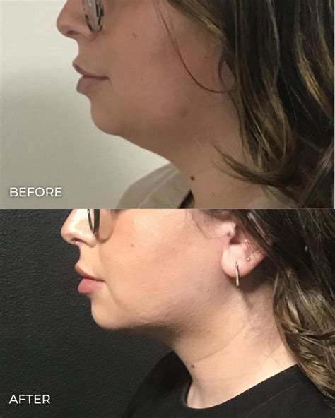 Guide To Coolsculpting For Double Chin Before And After