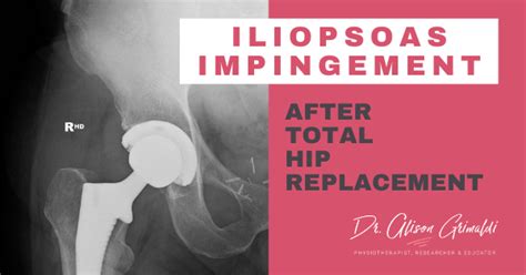 Iliopsoas Impingement After Total Hip Replacement Dr Alison Grimaldi