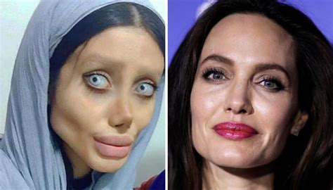 Woman With Angelina Jolie Plastic Surgery Before