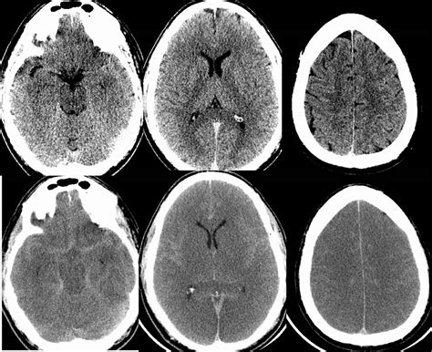 Cerebral Edema