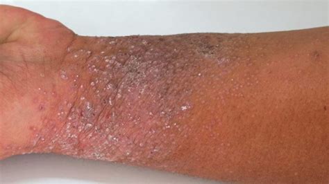 Atopic Dermatitis Dermatology Conditions And Treatments