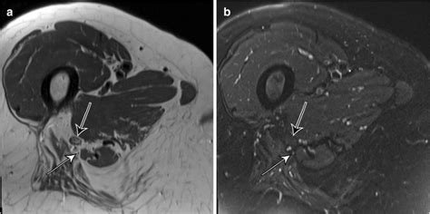 Mri Guided Cryoablation Of The Posterior Femoral Cutaneous Nerve For