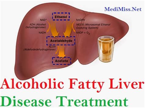 Alcoholic Fatty Liver Disease Treatment Medimiss