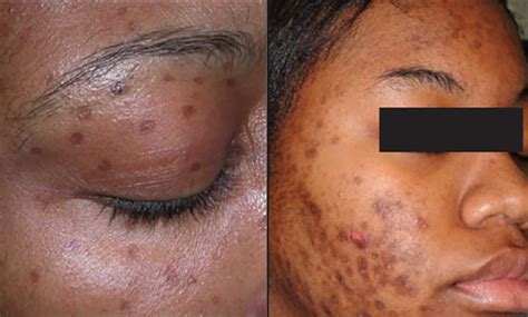 Skin Discoloration Causes And Dark Or White Skin Discoloration Treatment
