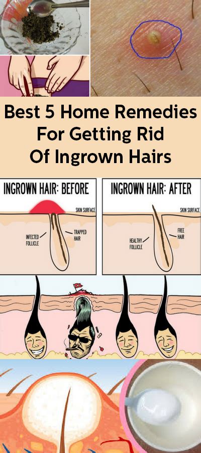 Best 5 Home Remedies For Getting Rid Of Ingrown Hairs Ingrown Hair