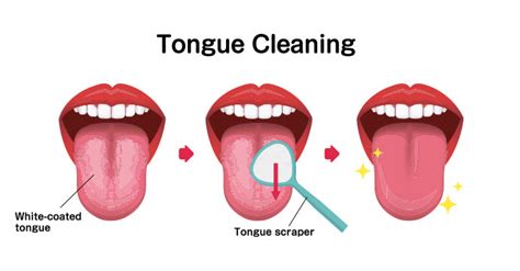 Black Hairy Tongue Causes Symptoms And Treatments Fairywill