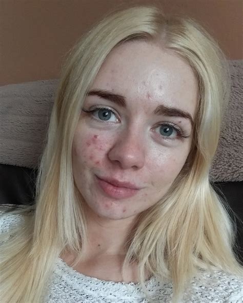Two Acne Positive Activists Tell Us Why They Share Unfiltered Photos Of