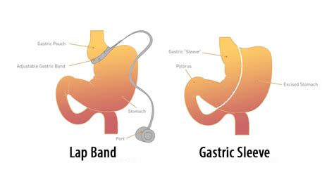 Lap Band Conversion To Gastric Sleeve Details Weight Loss Surgery