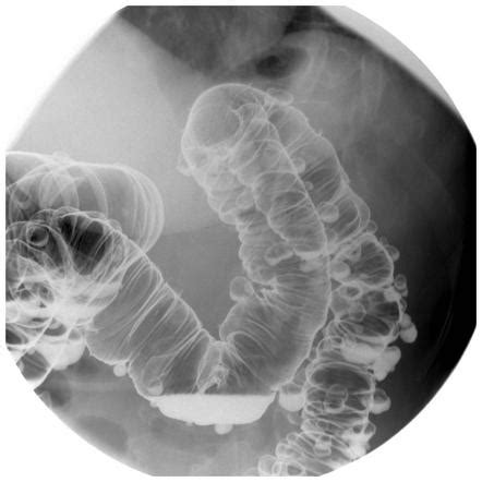 Diverticular Disease Radiology Reference Article Radiopaedia Org