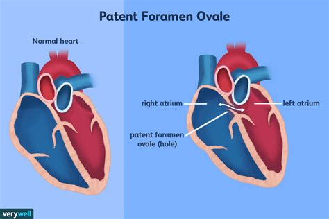 Patent Foramen Ovale And Migraines A Controversial Link