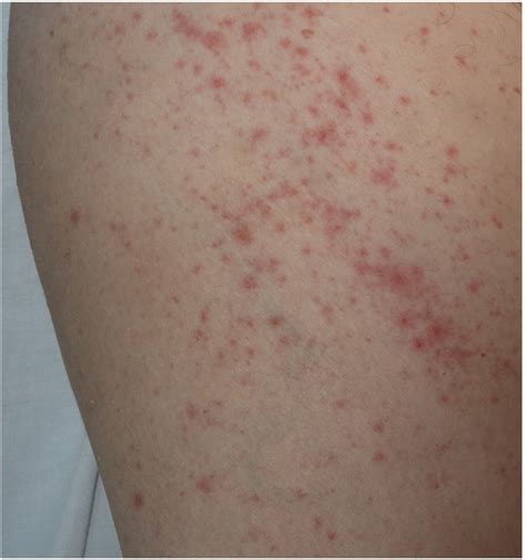 Maculopapular Rash In A Patient With Covid 19 Associated With Bilateral