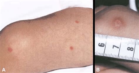 Typical Skin Lesions In Disseminated Fusarium Oxysporum Infection In A